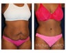 Abdominoplasty - Tummy Tuck