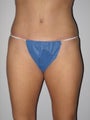 Tummy Tuck
