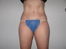 Tummy Tuck