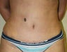 Tummy Tuck
