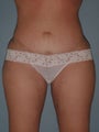 Tummy Tuck