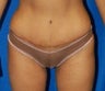 Tummy Tuck