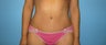 Beverly Hills tummy tuck