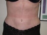 Tummy Tuck