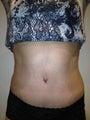 Tummy Tuck