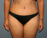 tummy tuck