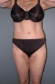 Tummy Tuck