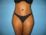 Tummy Tuck Beverly Hills