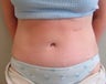 Tummy Tuck