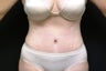 Tummy Tuck