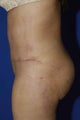 Tummy Tuck