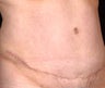 Tummy Tuck