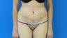 Tummy Tuck