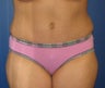Tummy Tuck
