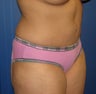 Tummy Tuck
