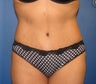Tummy Tuck