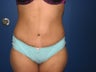 Tummy Tuck