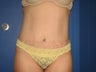 Tummy Tuck