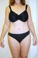Abdominoplasty