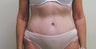 Tummy Tuck