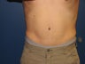 Male Tummy Tuck