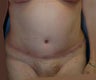 Tummy Tuck