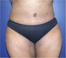 Tummy tuck (abdominoplasty)