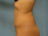 Tummy Tuck