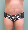 Abdominoplasty with Liposuction to Hips and Abdomen