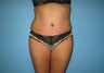 Tummy Tuck