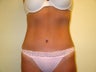 Tummy Tuck