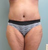 Abdominoplasty with Liposuction to Hips