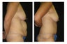 Tummy Tuck