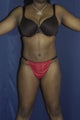 Abdominoplasty and liposuction to flanks