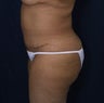 Abdominoplasty, liposuction to flanks and breast reduction