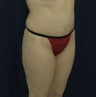 Abdominoplasty with liposuction to flanks