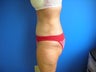 Tummy Tuck