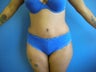 Tummy Tuck