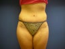 Tummy Tuck