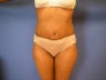 Tummy Tuck
