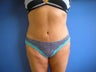 Tummy Tuck