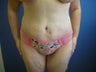 Tummy Tuck