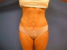 Tummy Tuck