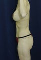 Abdominoplasty, liposuction to flanks, breast augmentation with full mastopexy