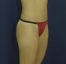 Abdominoplasty and breast enhancement with full breast lift