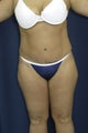 Abdominoplasty with liposuction to flanks and inner thighs