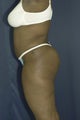 Abdominoplasty and liposuction to flanks