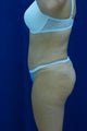 Abdominoplasty and liposuction to flanks and scapular