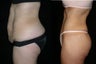 Tummy Tuck