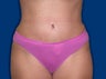 Tummy Tuck